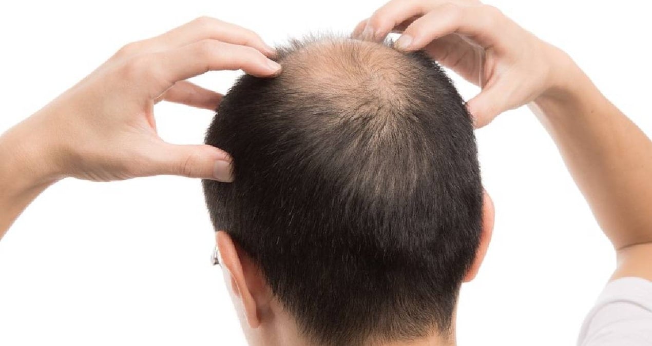 sac dokulmesini engelliyor kellik tarihe karisiyor Rel8aZiS